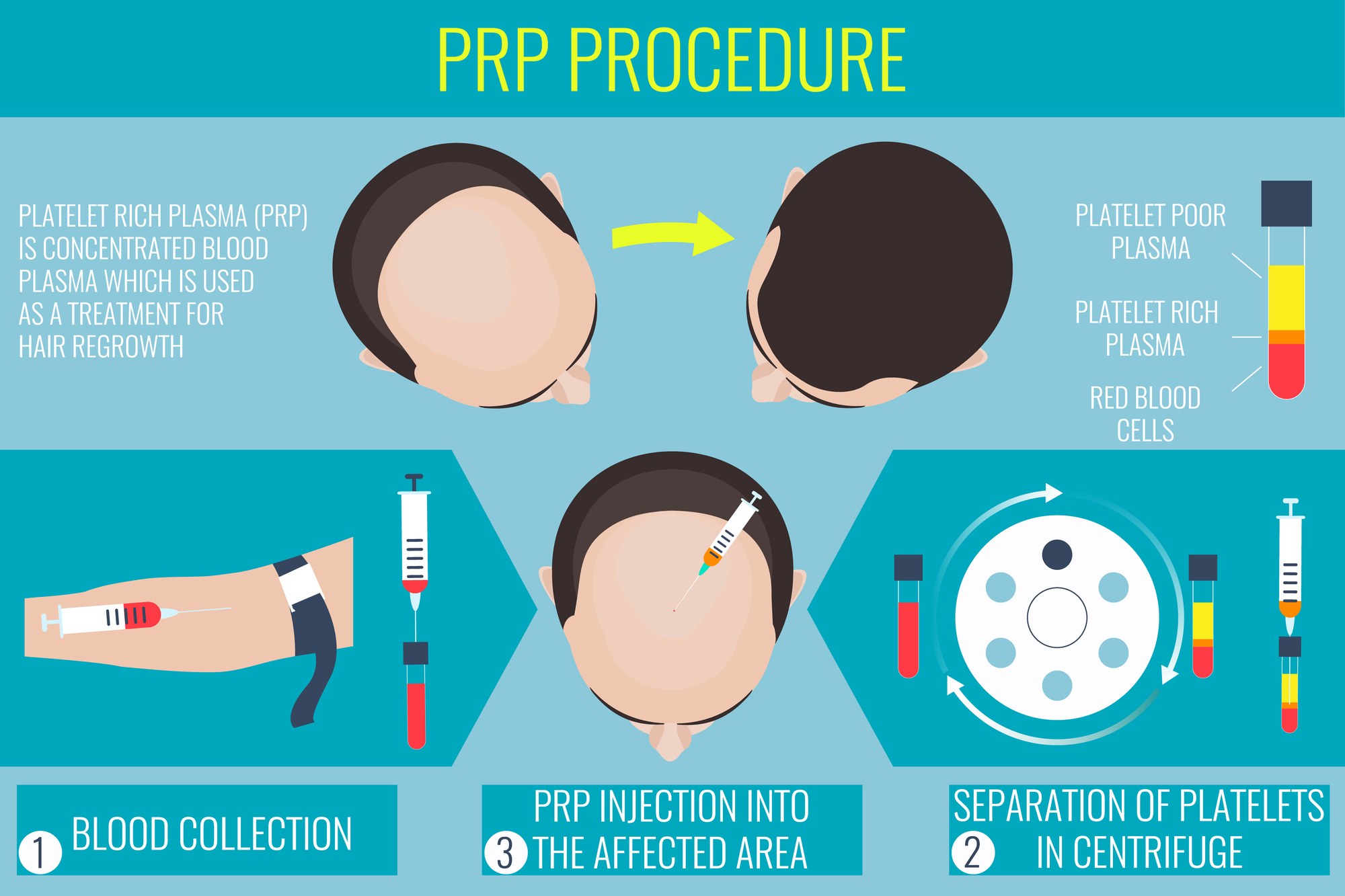 PRP Process