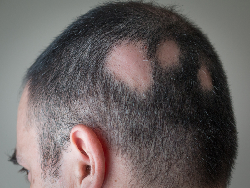 Hair Loss types - Alopecia Areata - A man's scalp with missing patches of hair