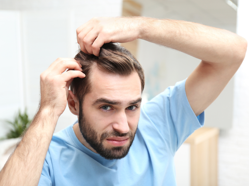 Hair Loss types - Androgenetic Alopecia (AGA) - Man's receding hairline