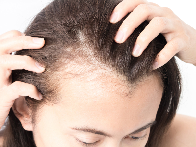 Hair Loss types - Androgenetic Alopecia (AGA) - Woman's receding hairline