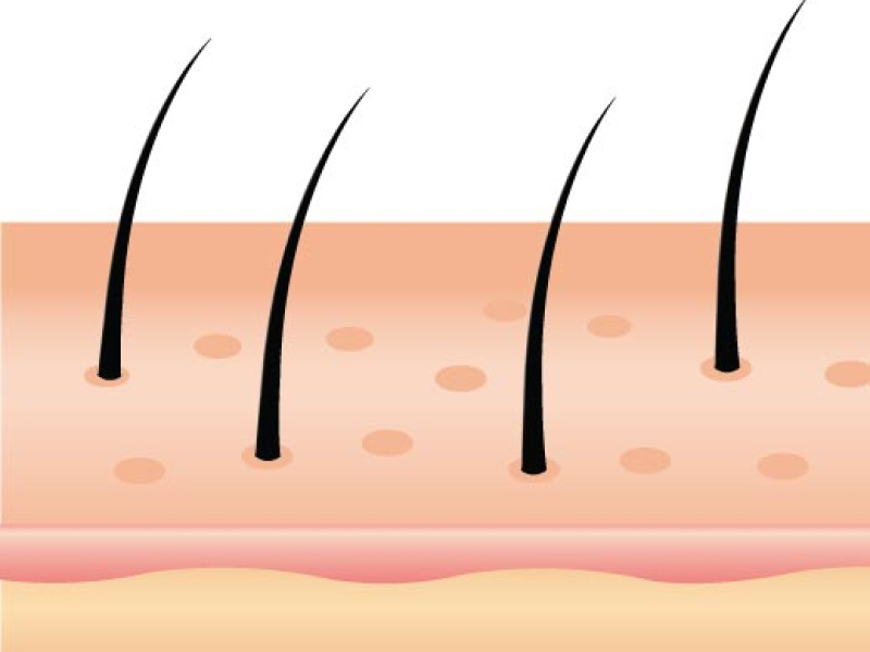 Hair Loss types - Cicatricial Alopecia - Diagram of missing hair follicles