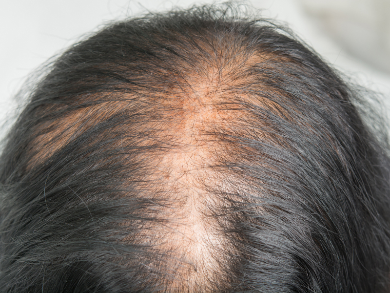 Hair Loss types - Telogen Effluvium - A man's scalp showing thinning hair