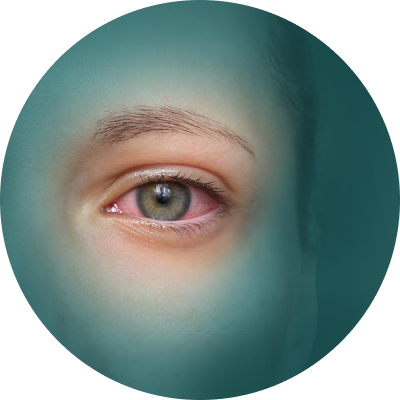 pain-dryeyesyndrome-400x400