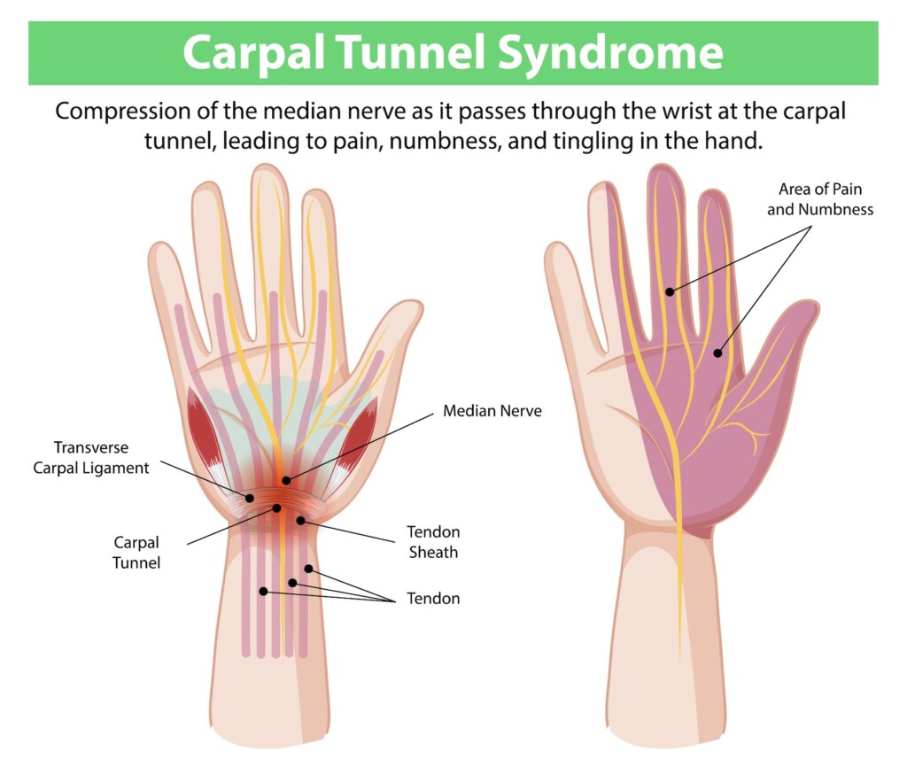 Carpal Tunnel Syndrome Diagram