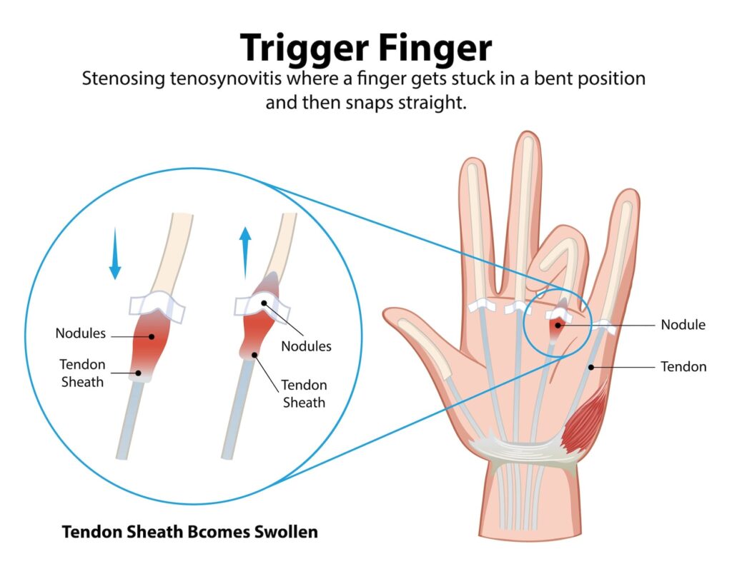 Trigger Finger diagram