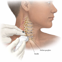 Stellate Ganglion Block image